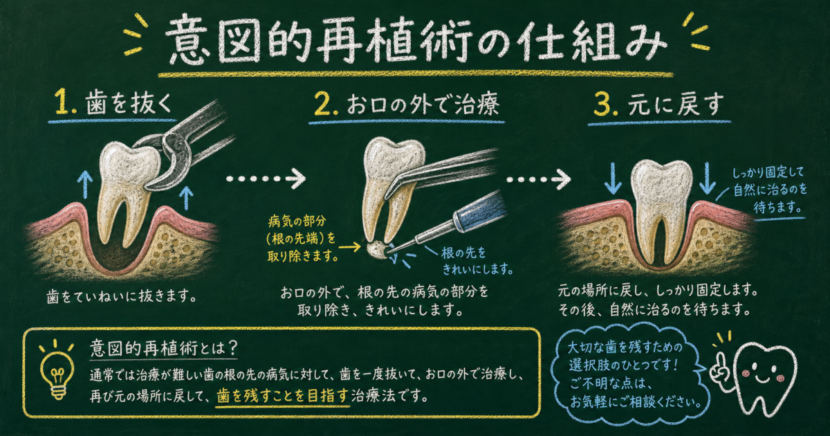 ■意図的再植術とは?一度抜いて戻す「歯の再植」の仕組み